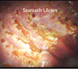 stomach-ulcer-pic